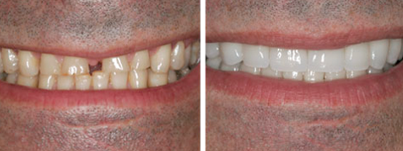 Veneers